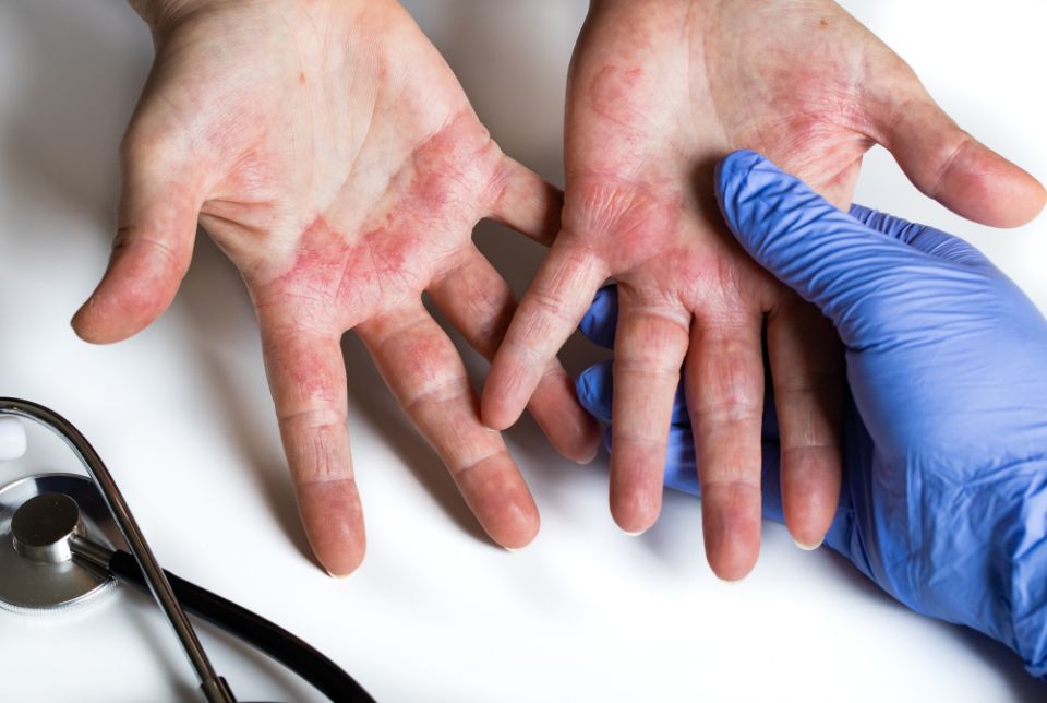 Servizio Telemedicina Dermatologia contro Dermatite Asti
